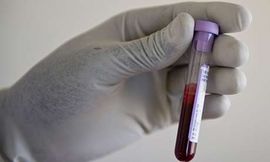 Besplatno testiranje na HIV 
