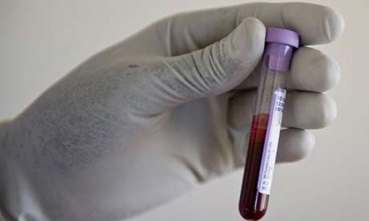 Besplatno testiranje na HIV 