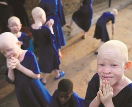 Zbog crne magije ubijeno nekoliko stotina albino Afrikanaca