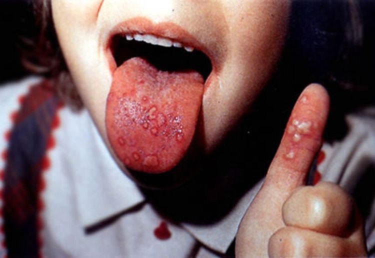 Epidemija oboljenja ruku, stopala i usta odnijela 70 života