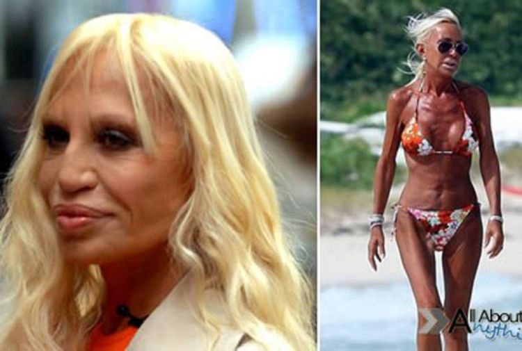 Sve više slavnih žrtve estetske hirurgije (Foto)