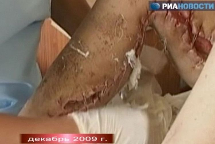 Uzela drogu krokodil koja razara tkivo