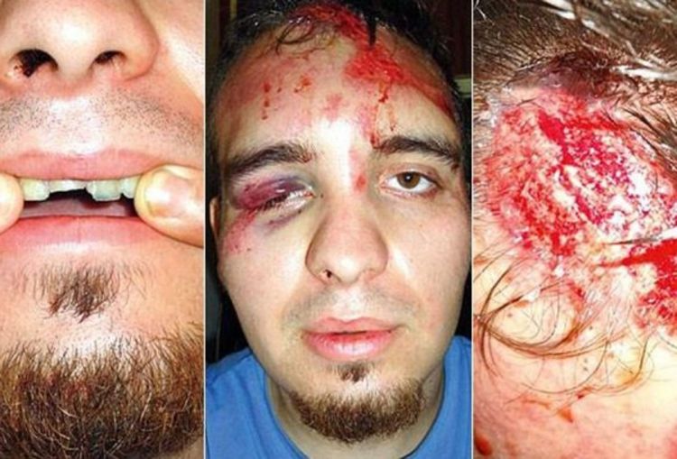Mladića napali, tukli i skalpirali usred Splita: Kožu su mi gulili s glave