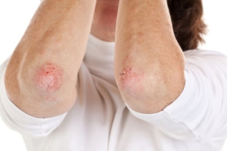 Psorijaza - bolest kože i imunološkog sistema