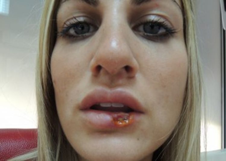 Porno glumica optužuje srpskog hirurga zbog deformacije usne