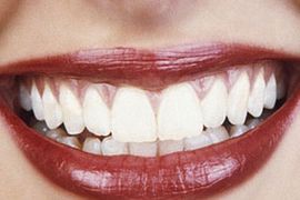 Sedam namirnica koje su najštetnije za zube