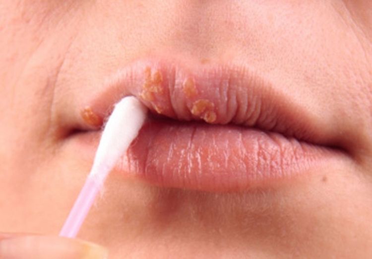 Spriječite herpes i riješite ga se prirodnim putem