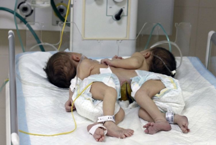 Palestinske bliznakinje spojene srcem ne mogu se razdvojiti