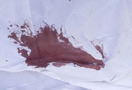 Djevojčica ranjena od metka, roditelji mislili - menstruacija