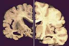 Naučnici sve bliže lijeku za Alzheimera