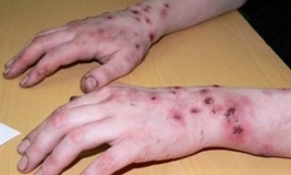 Droge "krokodil" nema u BiH