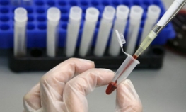 Test krvi predviđa rizik za šizofreniju