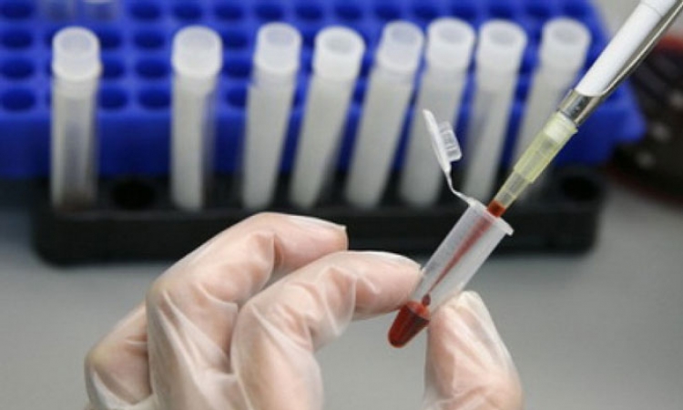 Test krvi predviđa rizik za šizofreniju