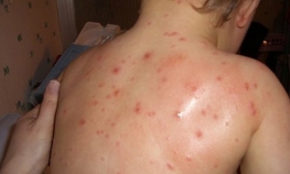 Epidemija morbila u 13 opština