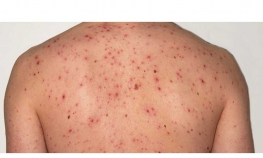 Proglašena epidemija morbila u Trebinju