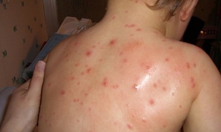Epidemija morbila u 13 opština