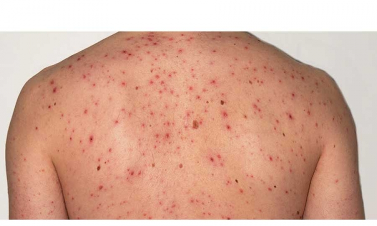 Proglašena epidemija morbila u Trebinju