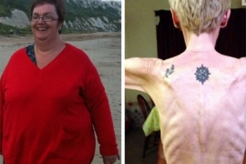 Od pretilosti do anoreksije: U dvije godine smršala 120 kg