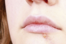 Herpes aktivira stres