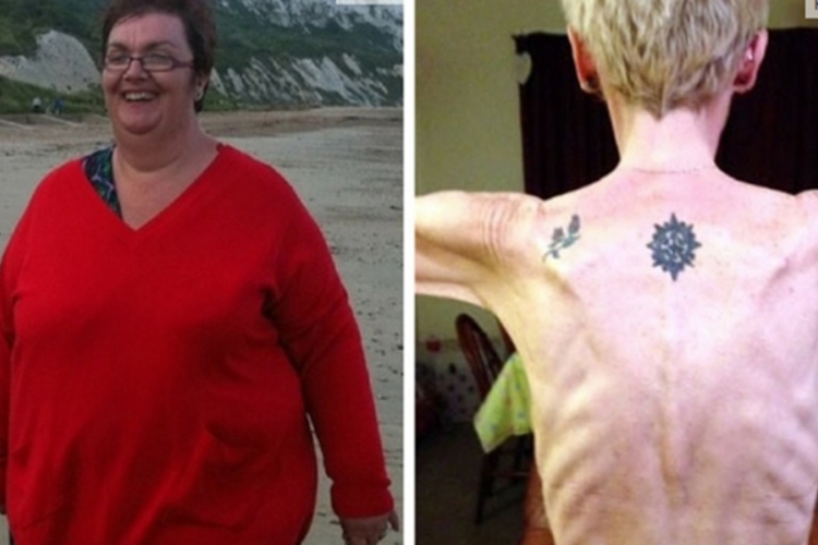 Od pretilosti do anoreksije: U dvije godine smršala 120 kg