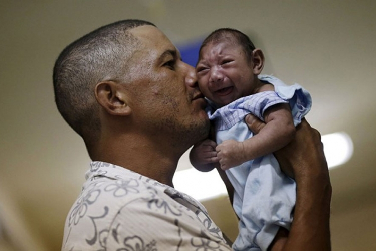 U Brazilu registrovano 4.690 slučajeva mikrocefalije