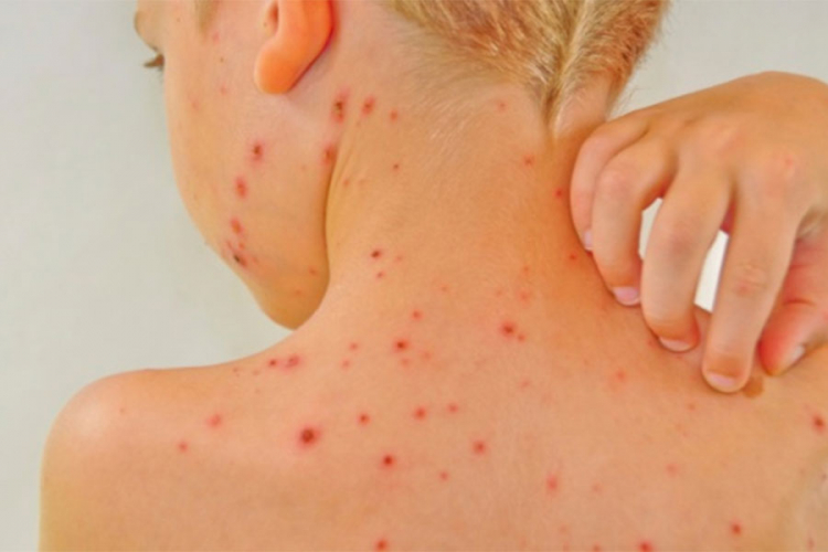 U Evropi sve više epidemija malih boginja