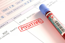 U Srbiji između 1.000 i 2.000 ljudi živi sa HIV-om, a ne zna