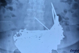 Doktori u stomaku Ruskinje pronašli 152 metalna predmeta