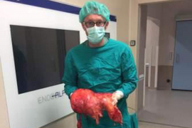 U Kliničkom centru Univerziteta Sarajevo odstranjen tumor od 11,4 ...