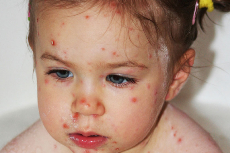 Veliki broj oboljelih u RS od vodenih ospica, stiže epidemija