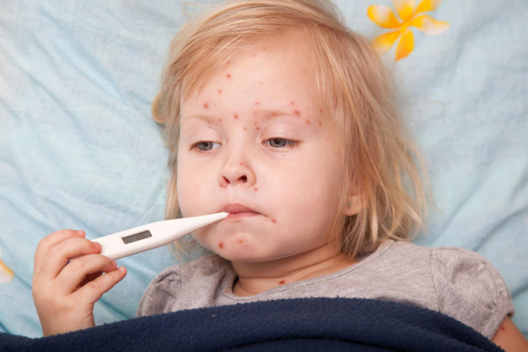 Registrovan i deveti slučaj morbila u BiH, još nije proglašena epidemija