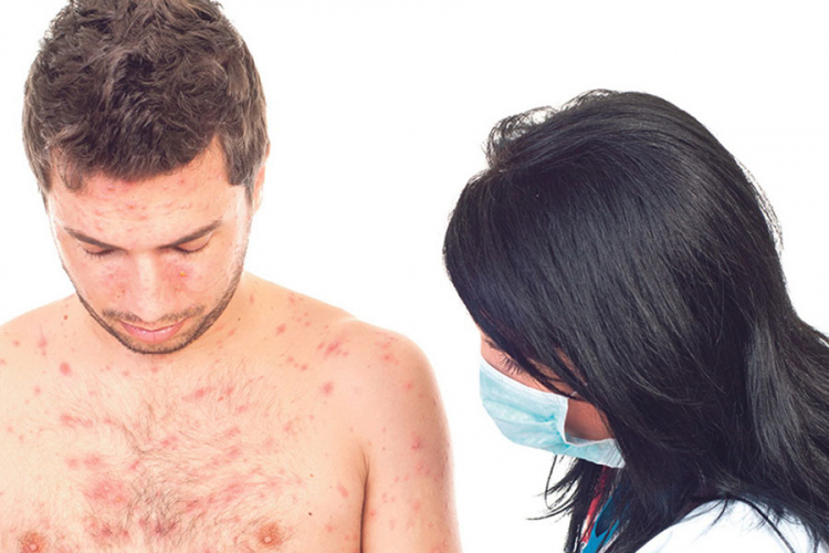 Epidemija morbila apel za vakcinaciju