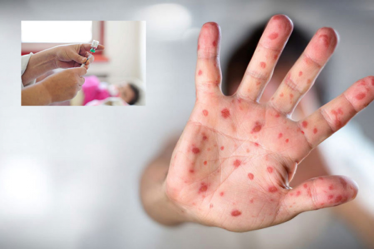 Stabilno stanje trudnice oboljele od morbila