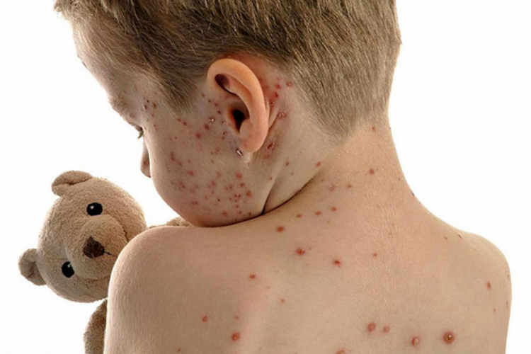 Epidemija morbila u Modriči