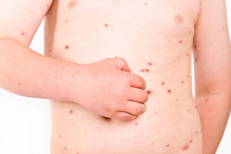U Banjaluci proglašena epidemija morbila