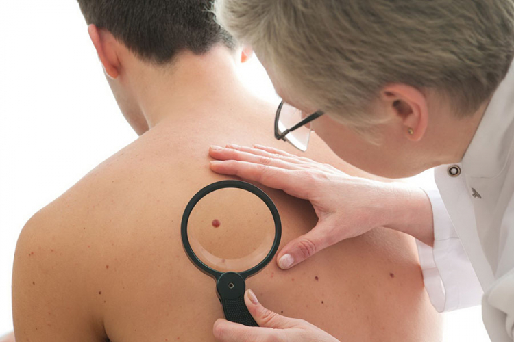 Efikasnija terapija za oboljele od melanoma