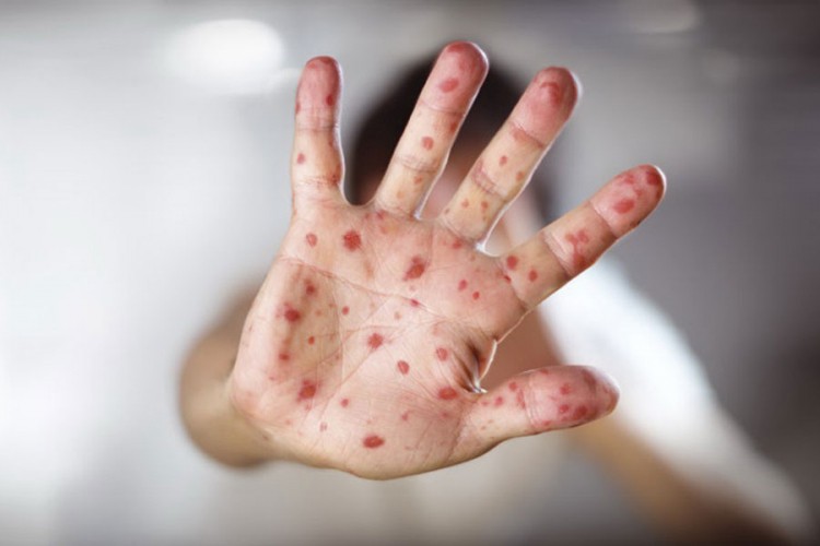 Porastao broj vakcinisane djece: Epidemija morbila opametila roditelje