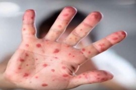 Epidemija morbila u Sarajevu, dvije bebe u teškom stanju