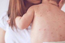 Dvogodišnje dijete hospitalizovano zbog morbila