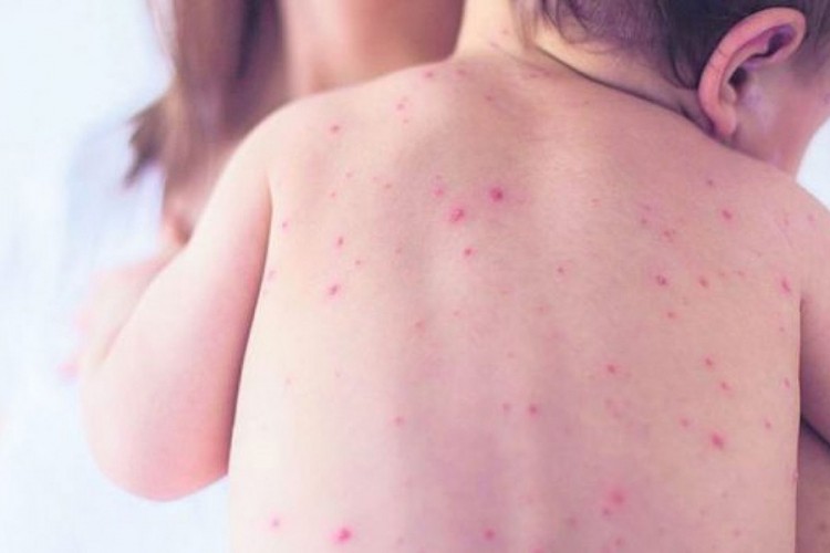 Morbile prijetnja za 60.000 osoba