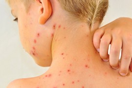 Epidemija u Zvorniku, od morbila oboljelo troje djece iz iste porodice