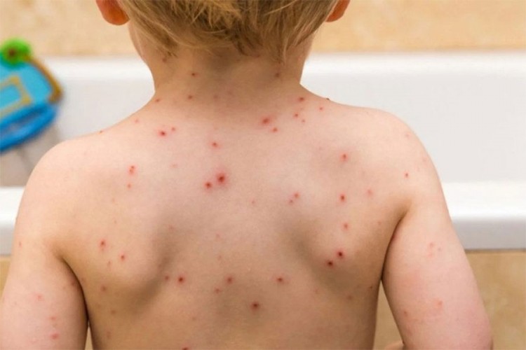 Epidemija morbila u Istočnom Sarajevu i Palama