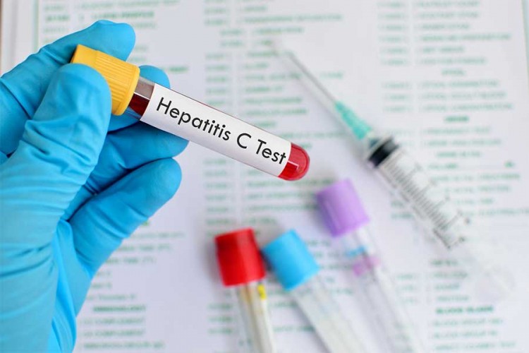Na hepatitise u UKS RS testirane 104 osobe, jedna sa pozitivnim rezultatom