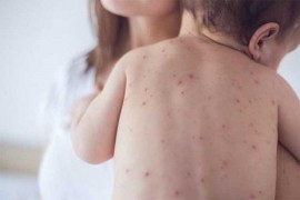 Najveća epidemija morbila od rata u FBiH
