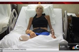 Amputirali mu nogu zbog male posjekotine koju je zadobio na plaži