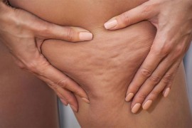 Doktorka želi da znate istinu: Ono što svi misle o celulitu je mit