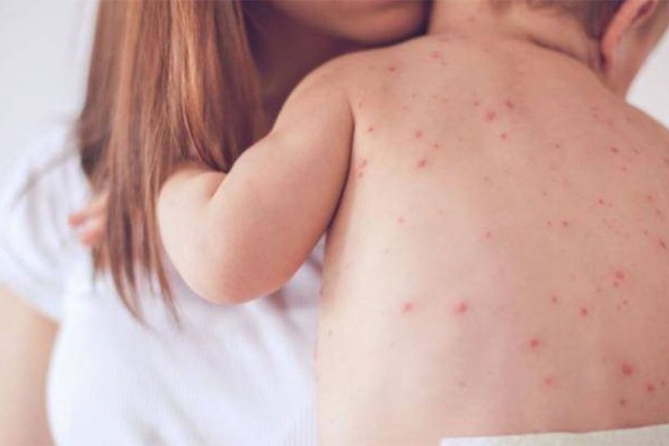 U FBiH više od 1.300 građana oboljelo od morbila