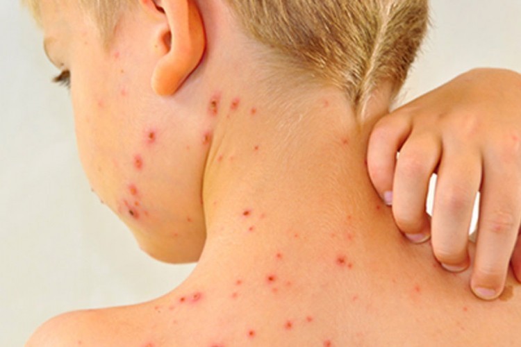 Zagreb u strahu zbog moguće epidemije boginja