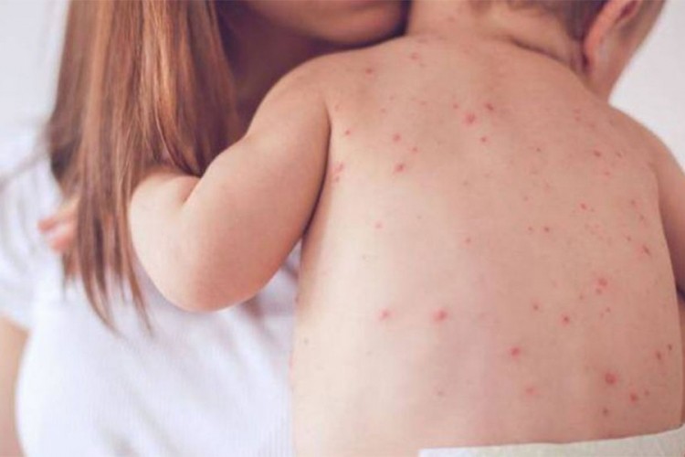Epidemija ospica u Hrvatskoj