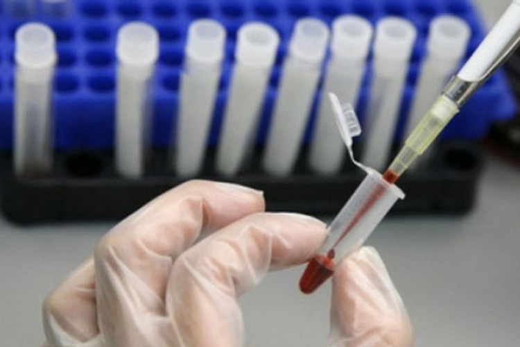 Test krvi detektuje rak dojke pet godina prije pojave simptoma